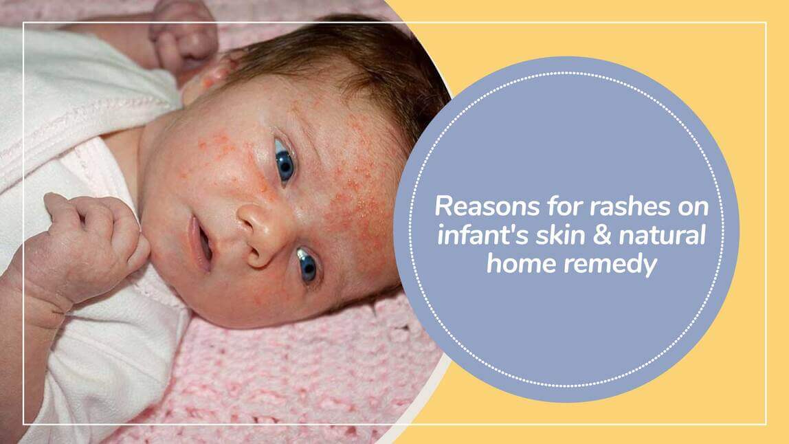 Baby Rashing Reasons for rashes on Infant Skins and How to treat them naturally at